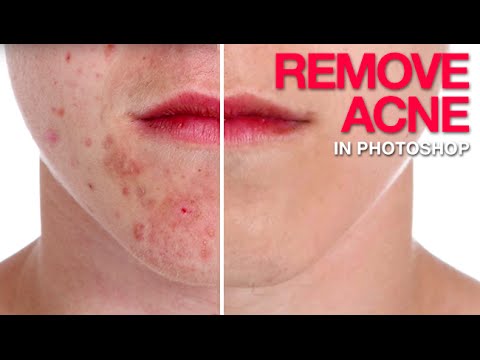 Bye-Bye Blemishes: A Practical Photoshop Guide to Removing Acne Without Destroying Skin